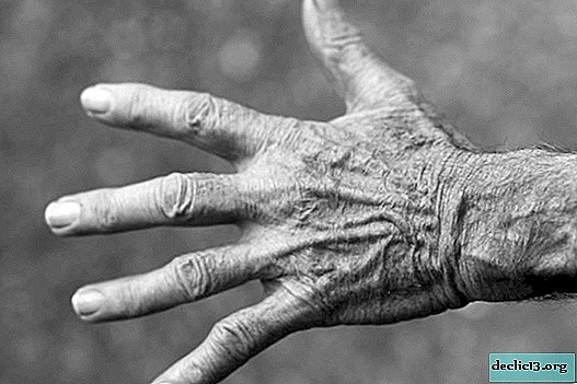 Bệnh chàm ở tay: cách điều trị, loại và triệu chứng, cách chữa đúng