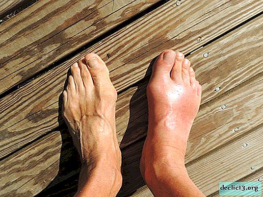 Gout - signs, symptoms, drug and alternative treatment