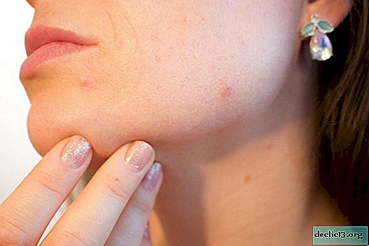 Chickenpox in adults: symptoms, treatment, incubation period